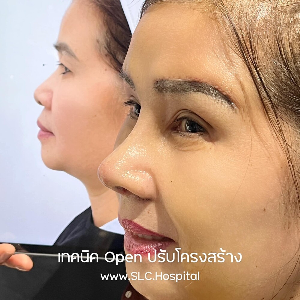 Before and After Result